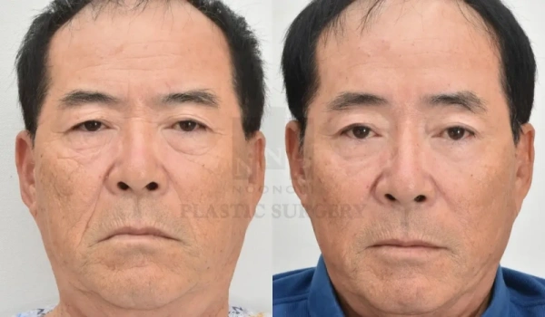 术前与术后6周对比