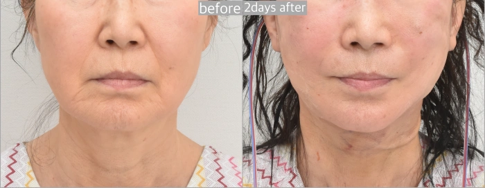 Timeline of facelift Swelling: Day 2, 4, and Week 2