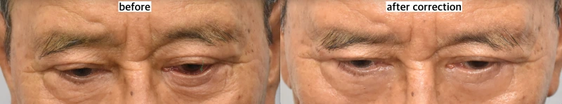 ectropion correction korea