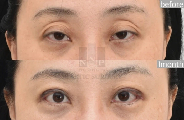 切开式眼睑下垂手术前后对比