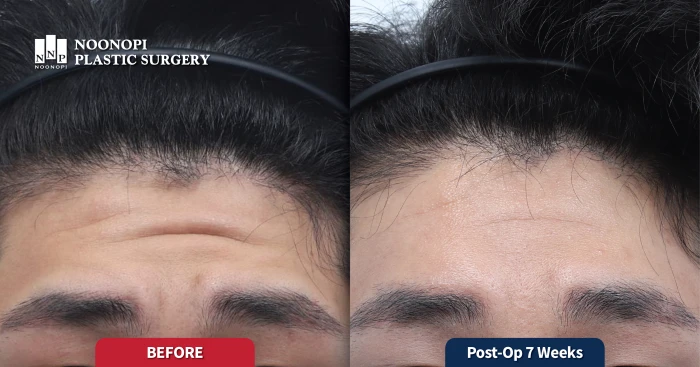 Patient using forehead muscles to open eyes, causing deep wrinkles