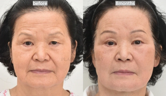 78세의 안면거상 목거상 이마거상술 전후