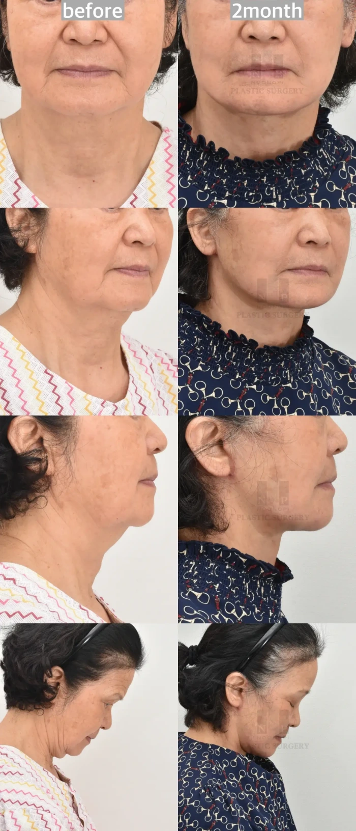 face and neck lift before after
