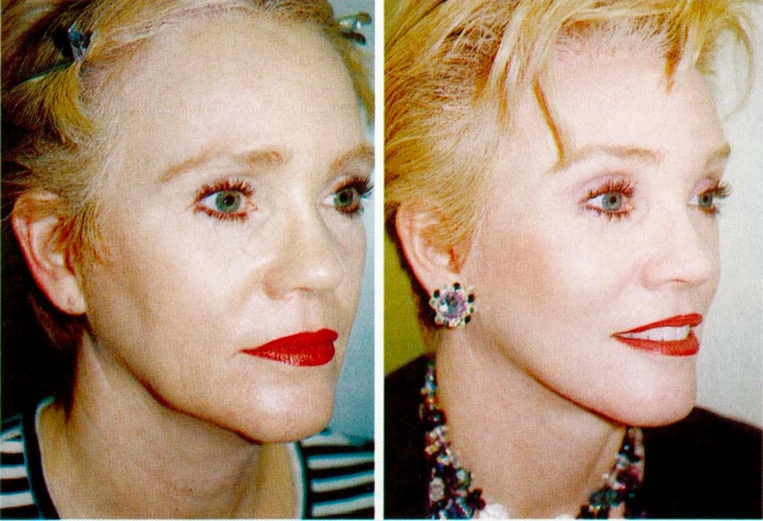 关于额头提升术中发际线矫正的 Marten 论文摘要