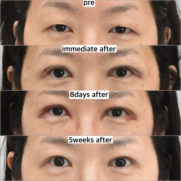ptosis re-operation