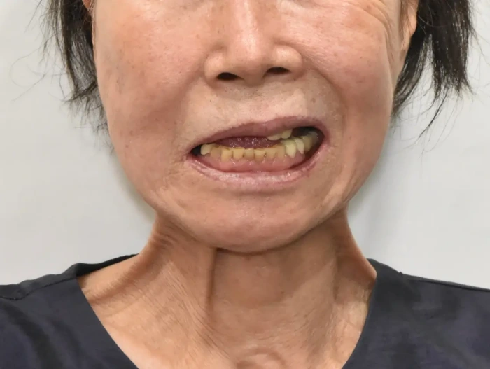 Case of nerve damage after facelift(by unknown surgeon)