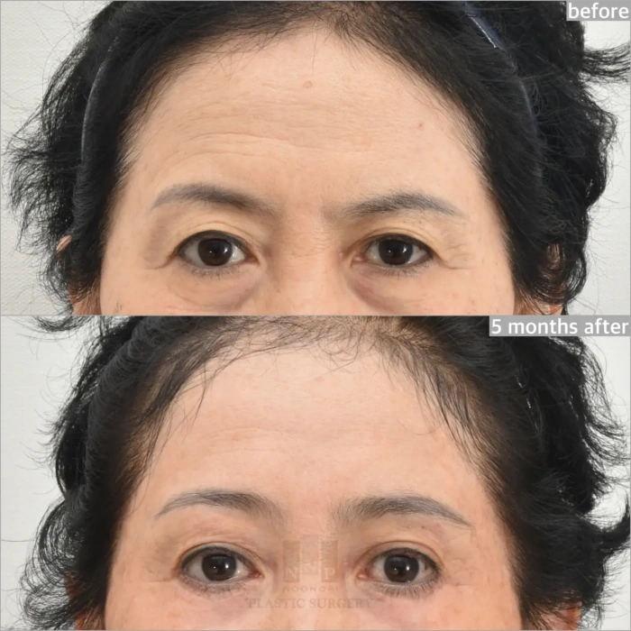 forehead lift before after 5months