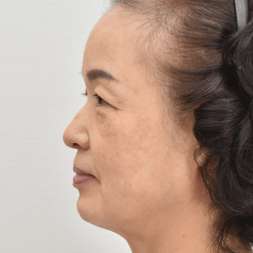 面颈部提升术侧面效果（术后3个月）