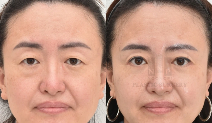 جراحة تجميل الجفن العلوي الكوري قبل وبعد