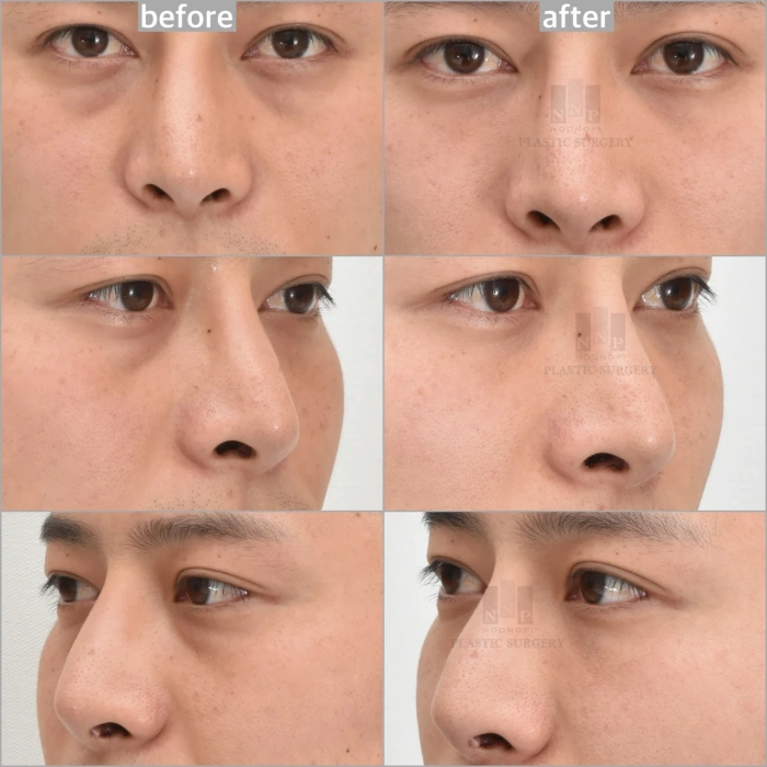 dark circle nano fat graft