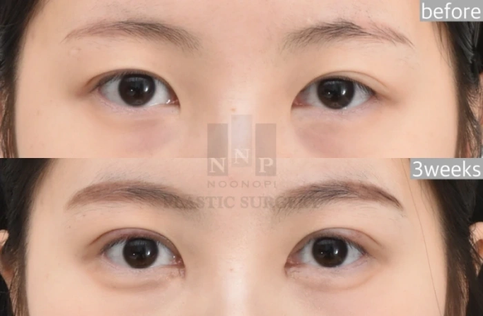 韩国眼睑下垂矫正费用