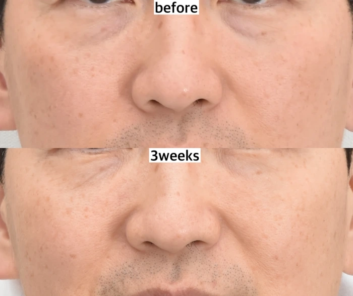 بعد 3 أسابيع من إعادة وضع الدهون وزرع الدهون النانوية: قد يبدو الجفن السفلي مترهلًا إذا لم يتم معالجة ترهل الجلد بشكل صحيح.