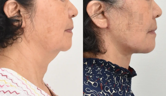 صورة تظهر النتائج الواضحة لـ شد الوجه والرقبة لمريضة 70 عامًا لاستعادة شباب البشرة.