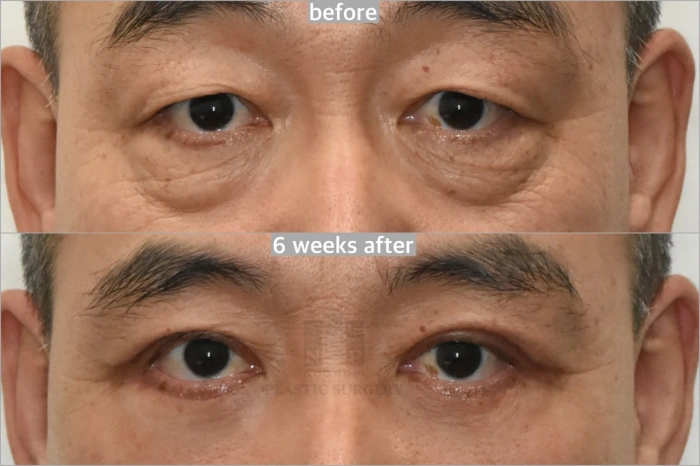 upper and lower blepharoplasty 6weeks after