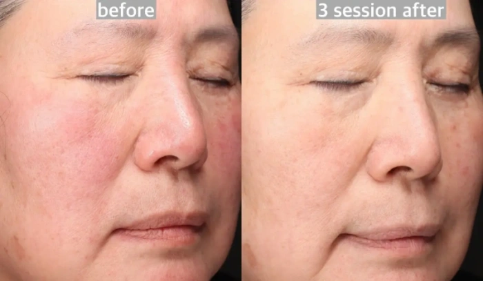 facial redness BBL results