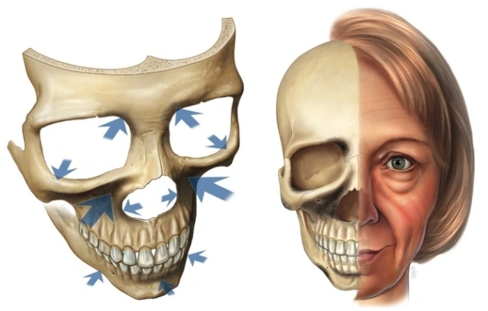 面部骨骼随年龄增长逐渐萎缩