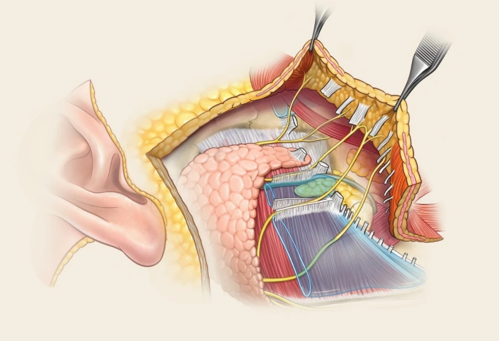 facelift illustration