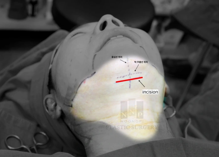 Short scar neck lift incision location