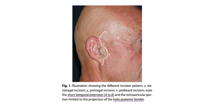 Article introducing a limited incision in balding patients due to concerns about incision scarring
