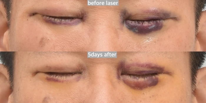 علاج الاحمرار بالليزر BBL