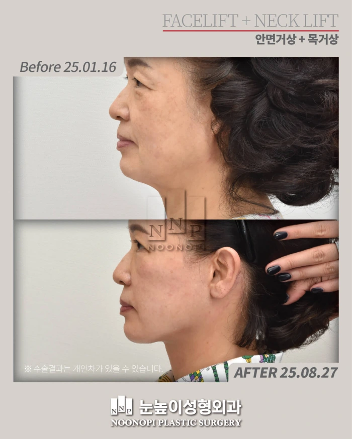 face and neck lift korea