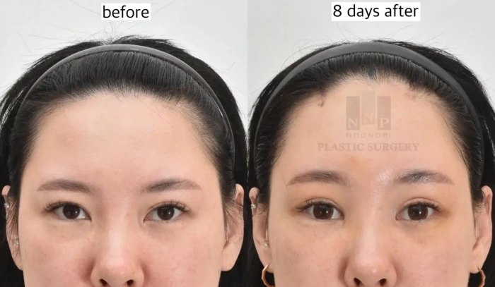 Endoscopic brow lift in young patient