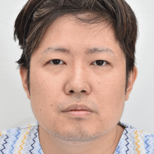 眼睑下垂矫正+睑角成形术+内眦提肌术 术后10天