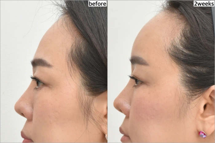 زرع الدهون في الجبهة قبل أسبوعين وبعد