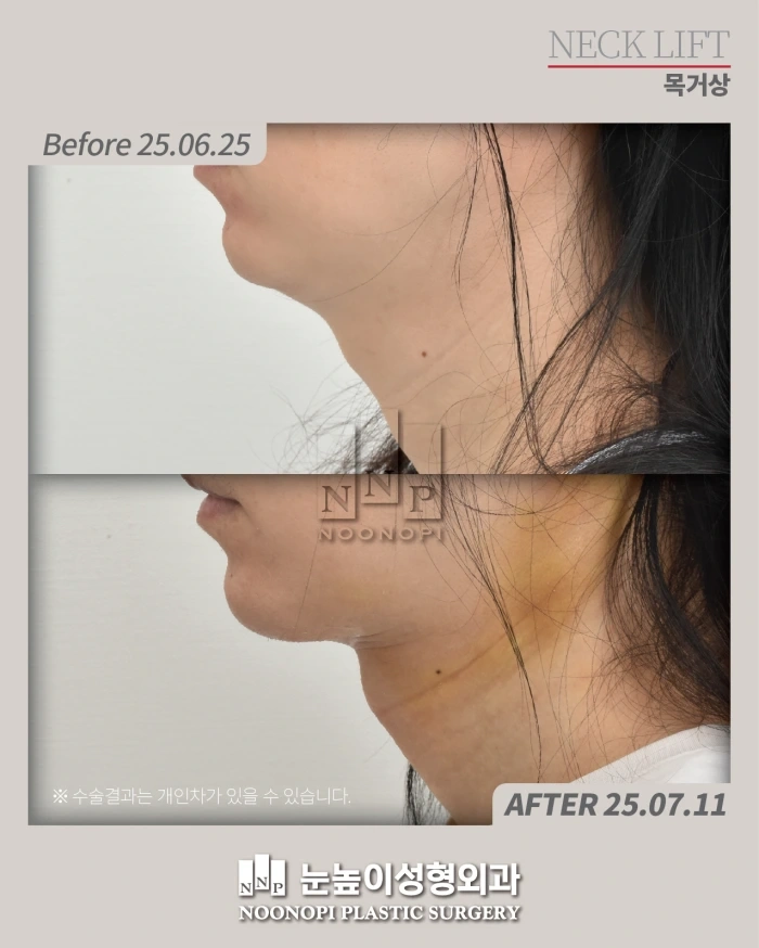 韩国全颈部提升术前后对比
