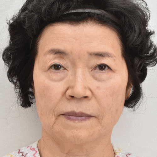 下睑成形术术前3个月 术后