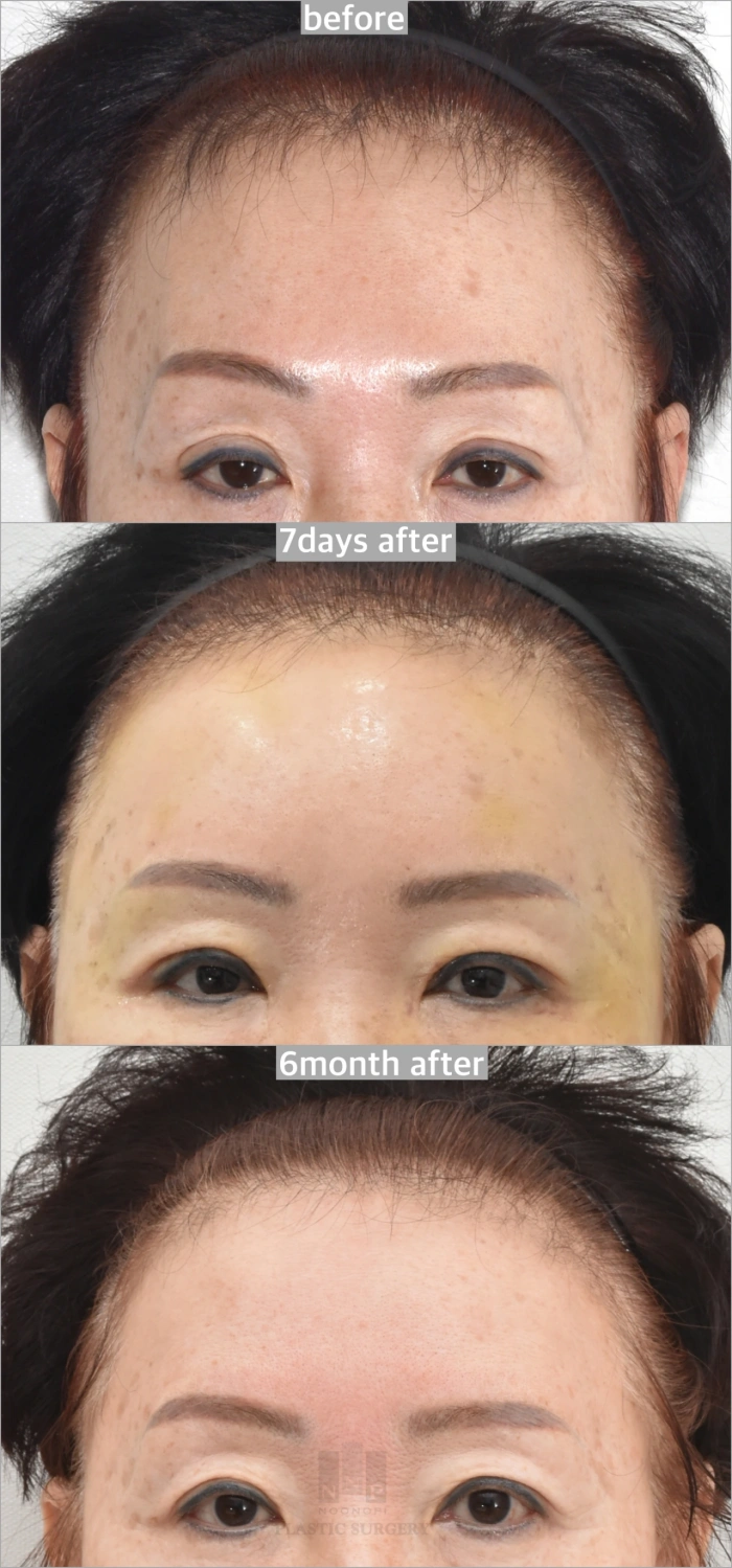 upper lid fat graft korea