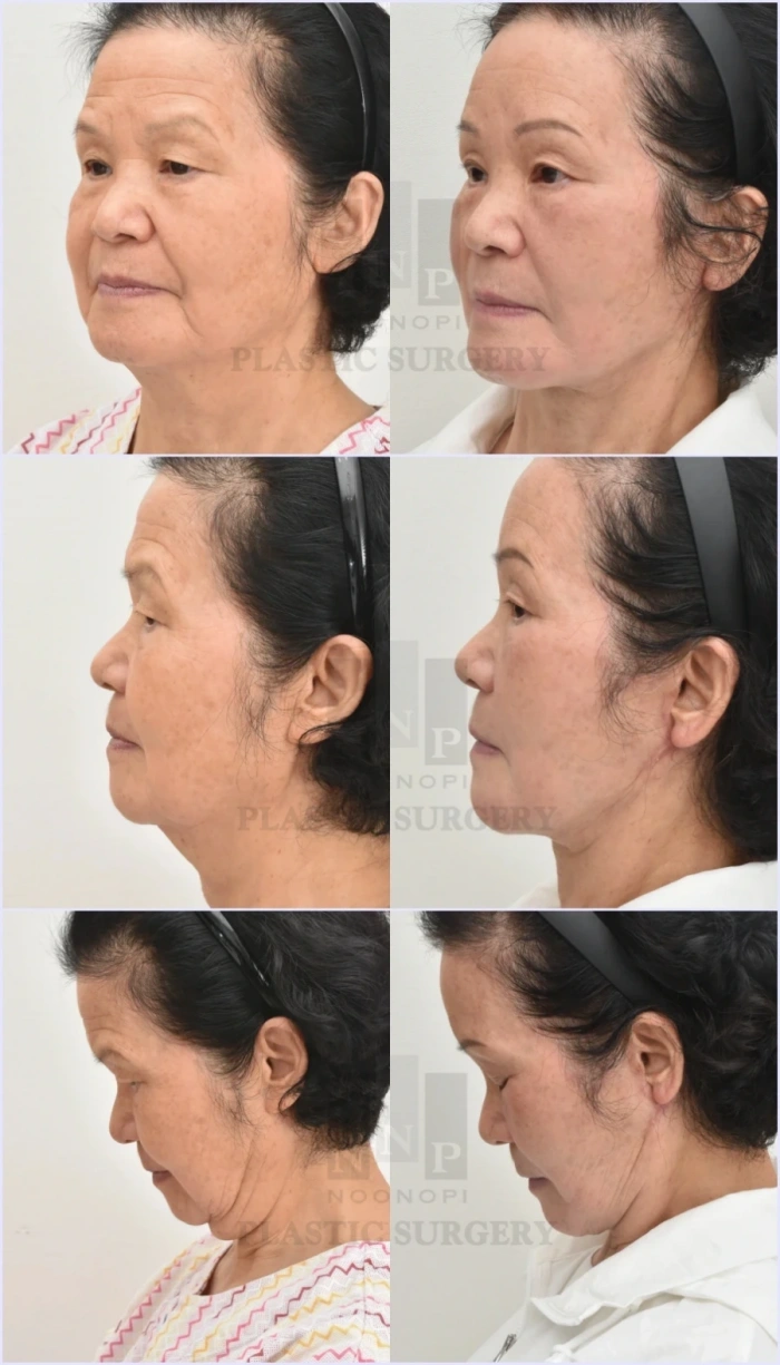 颈部屈曲状态下,精细矫正下颌及颈部松弛组织