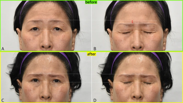 双眼皮手术前后眉位变化对比, 红箭头所示区域眉毛下移幅度