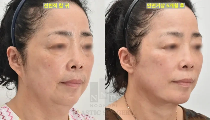 面部提升术后发际线无可见疤痕(Noonopi Nk Park医师)- 长期效果