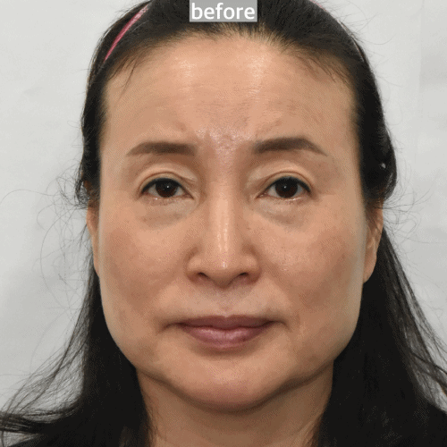 안면거상 전후 사진