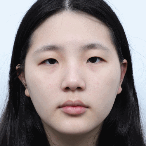 쌍꺼풀 눈매교정 차이