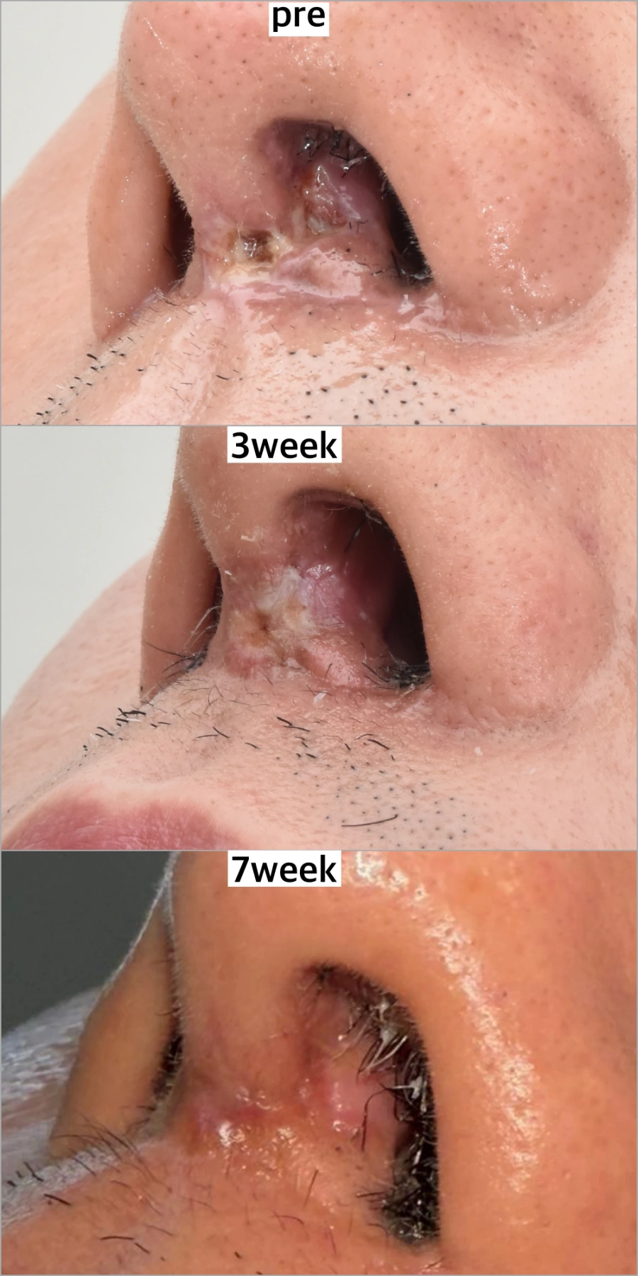treatment of skin necrosis after nose surgery