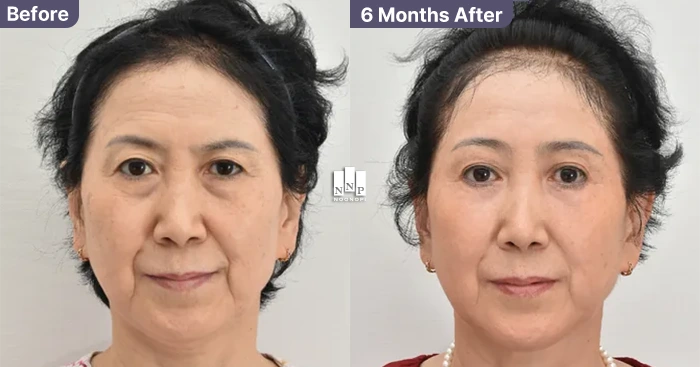 Endoscopic brow lift before after in Asian patient