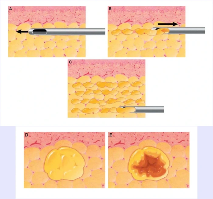正确注射技术—多层注射