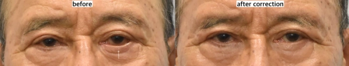 تمت إعادة بناء الجفن المقلوب الأيسر (السهم الأبيض) بواسطة Noonopi