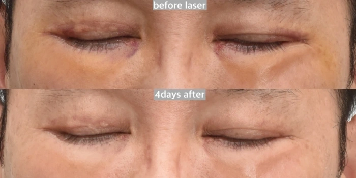 مثال على كدمة ما بعد الجراحة تم علاجها بالليزر