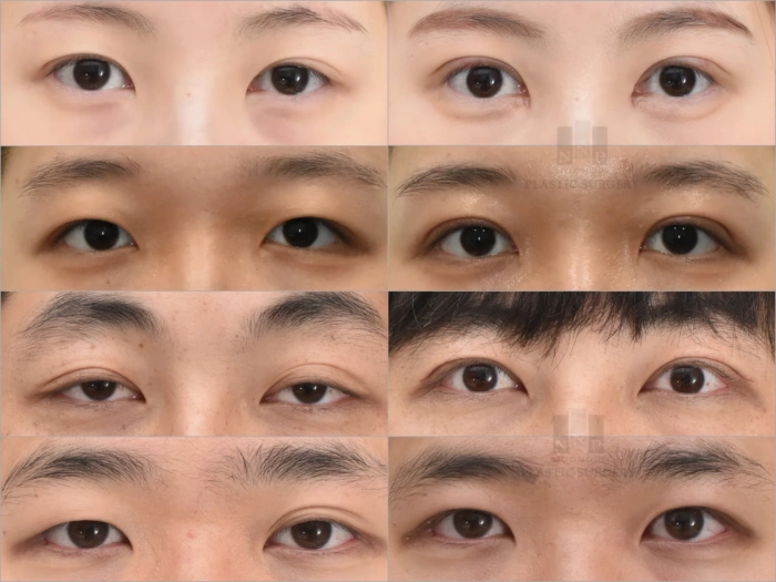 العيون المناسبة لتقنية الطية المزدوجة الجراحية