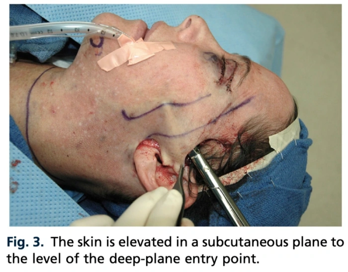 复合除皱术中的皮肤分离范围（参考链接）