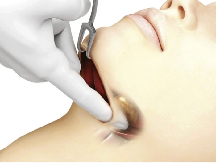 直视操作使手术更精准