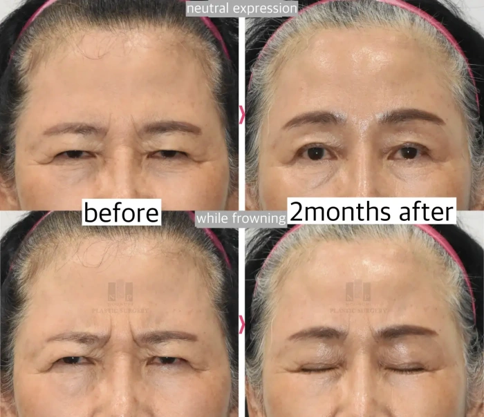 模拟肉毒杆菌效果—改善眉间纹