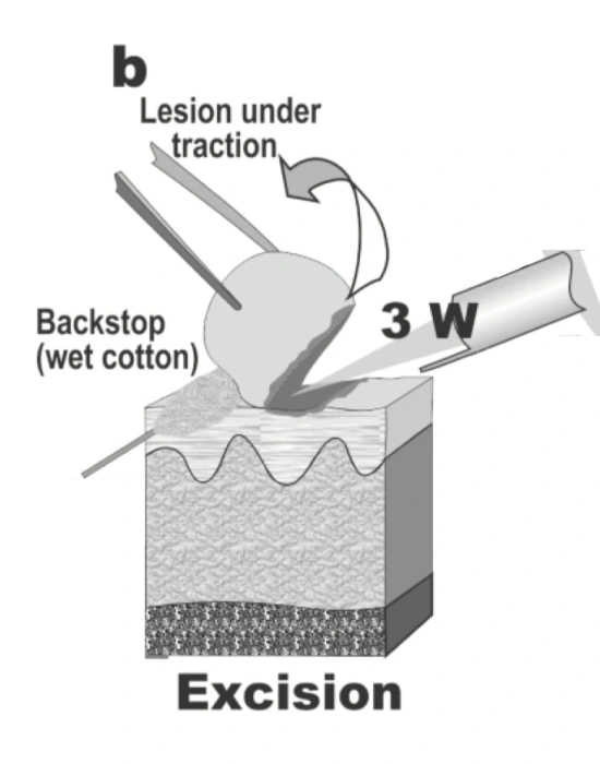 皮肤赘疣切除术可在用水浸湿的棉球保护周围组织的情况下进行