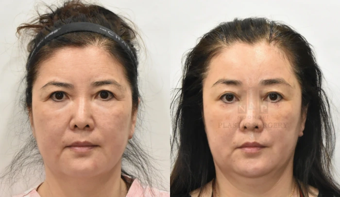 droopy eyebrows before after
