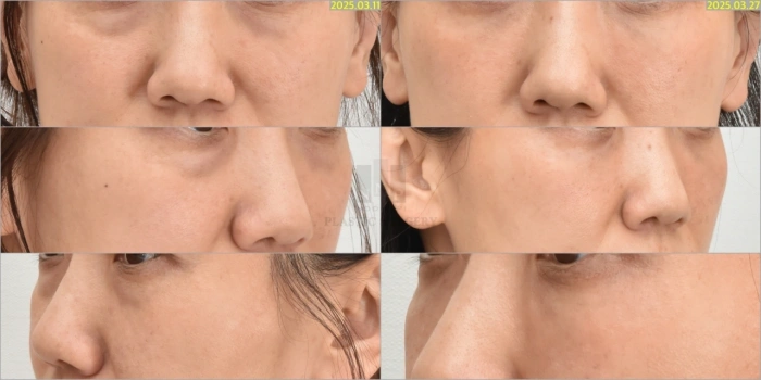 تجميل الجفن السفلي بدون شقوق قبل وبعد