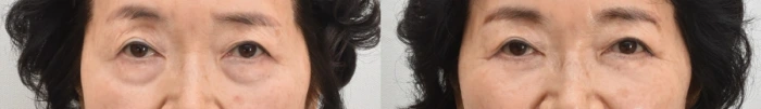 lower blepharoplasty results in 60s female patient