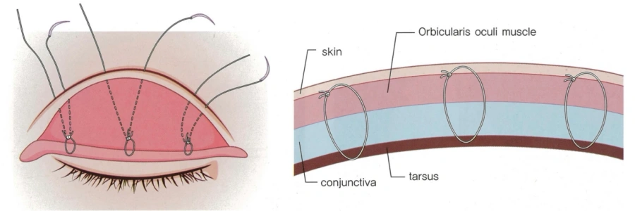 how non-incisional double eyelid works